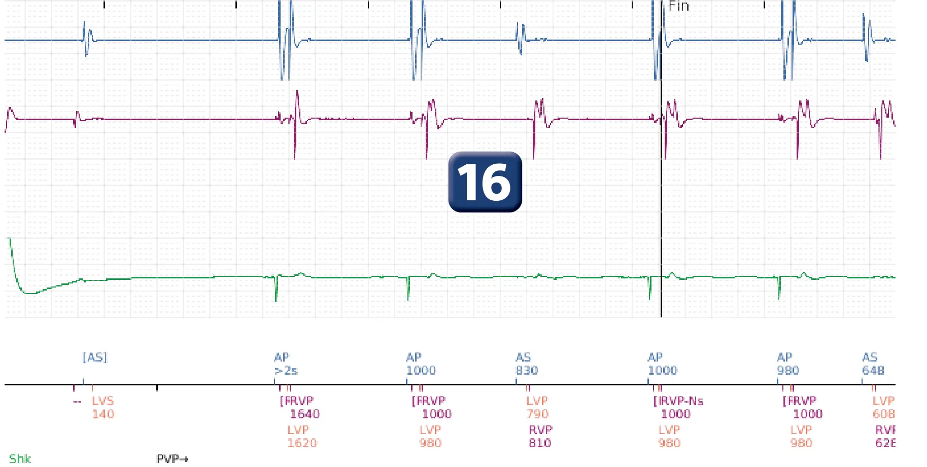 Électrogramme Boston Scientific DAI, segment 12 sur 12 — Série de chocs électriques en zone de FV