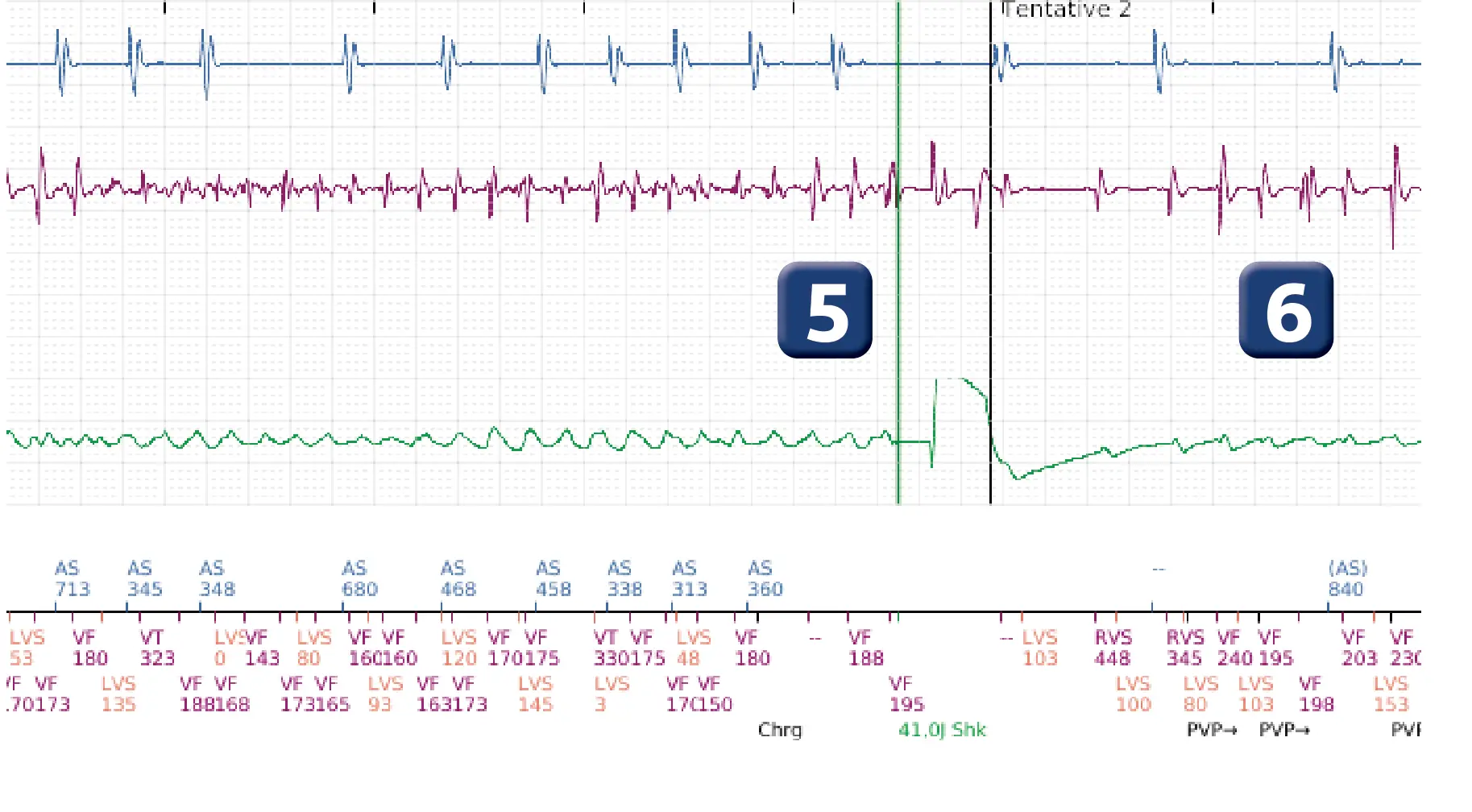 Électrogramme Boston Scientific DAI, segment 4 sur 12 — Série de chocs électriques en zone de FV