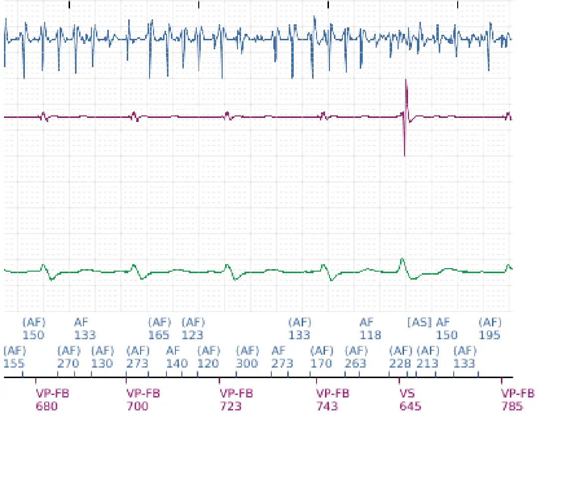 Électrogramme Boston Scientific DAI, segment 7 sur 7 — FV, choc électrique et induction de FA