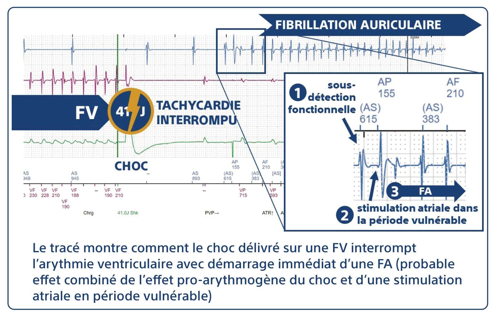 Le tracé montre comment le choc délivré sur une FV interrompt l’arythmie ventriculaire avec démarrage immédiat d’une FA (probable effet combiné de l’effet pro-arythmogène du choc et d’une stimulation atriale en période vulnérable)
