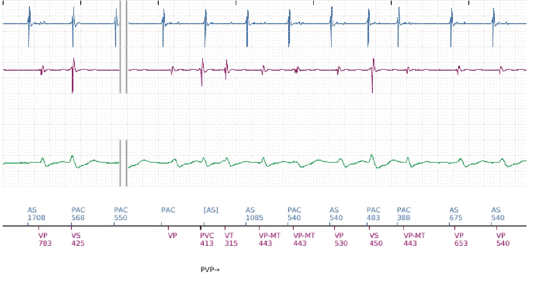Électrogramme Boston Scientific DAI, segment 9 sur 12 — Salve d’ATP en zone de FV