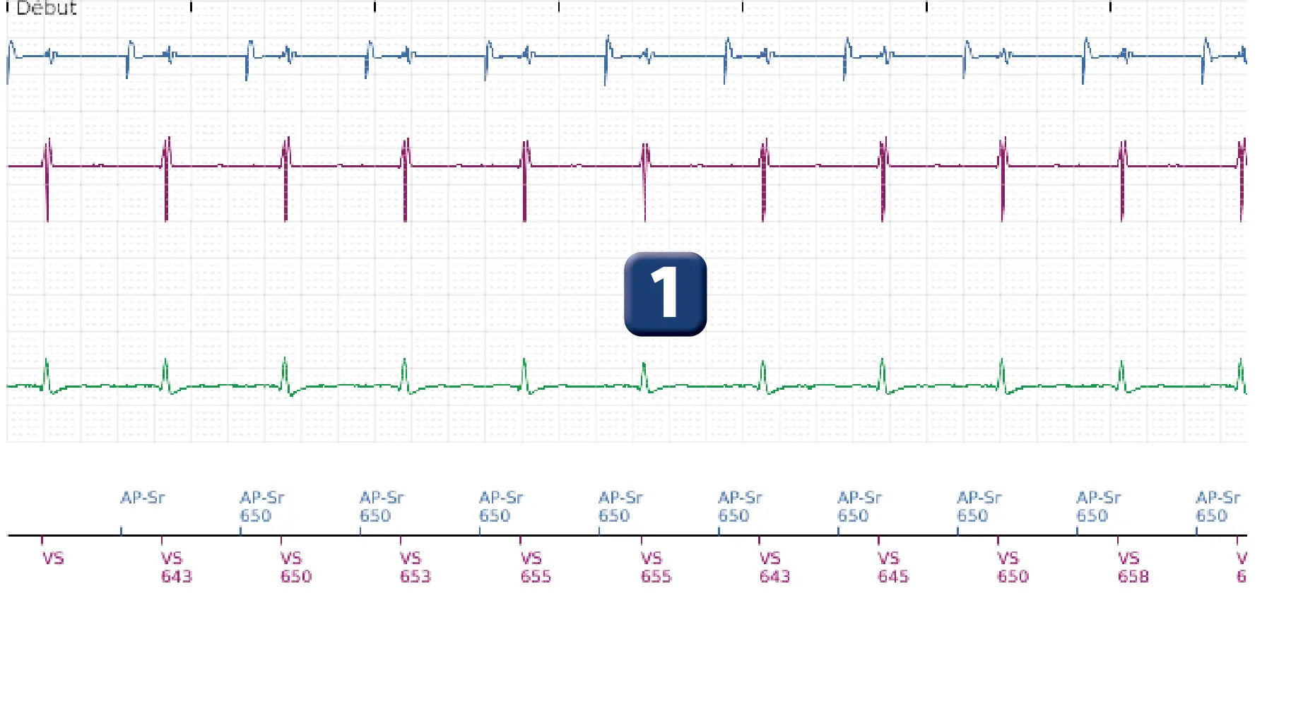 Électrogramme Boston Scientific DAI, segment 1 sur 5 — Sous-détection, erreur de calcul de la fréquence et salve d’ATP en zone de FV