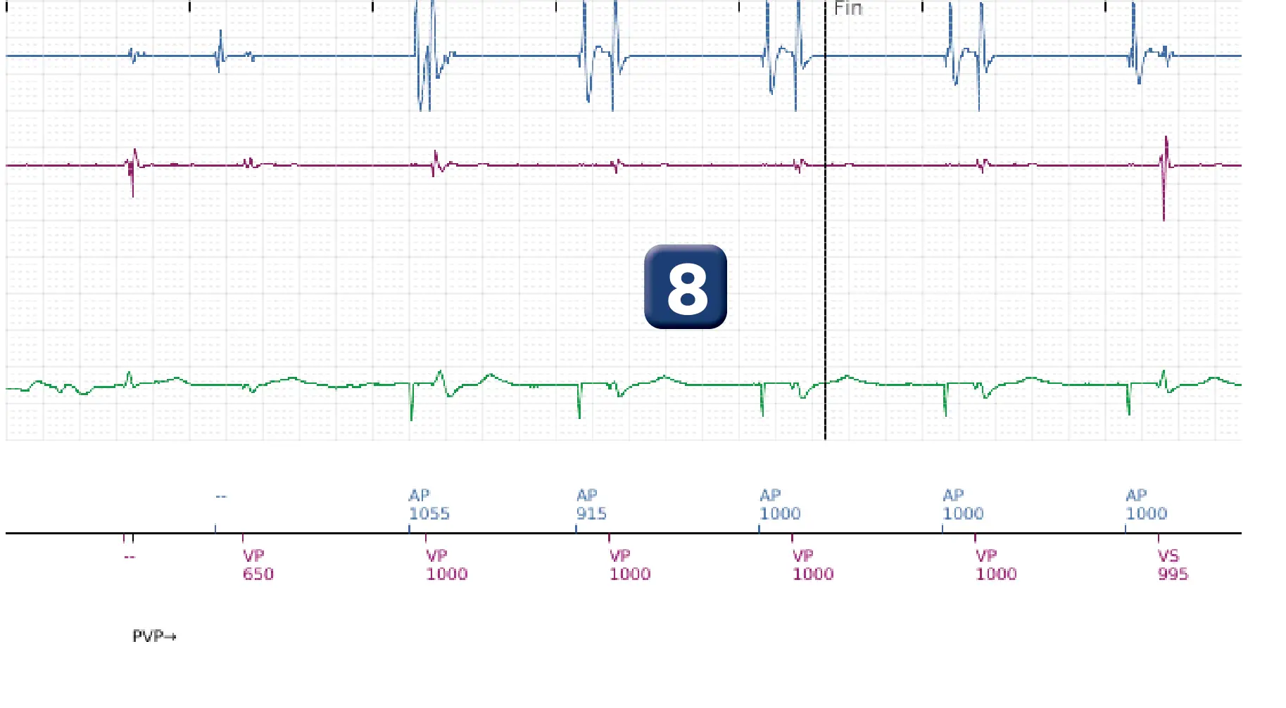 Électrogramme Boston Scientific DAI, segment 5 sur 5 — Sous-détection, erreur de calcul de la fréquence et salve d’ATP en zone de FV