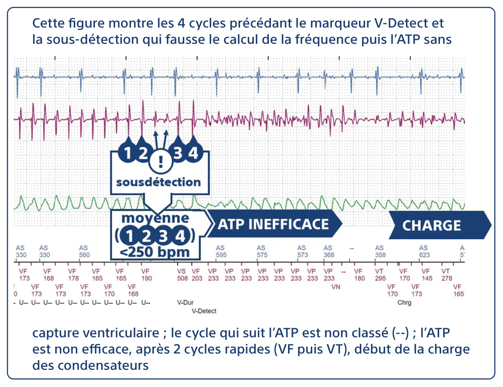 Cette figure montre les 4 cycles précédant le marqueur V-Detect et la sous-détection qui fausse le calcul de la fréquence puis l’ATP sans capture ventriculaire ; le cycle qui suit l’ATP est non classé (--) ; l’ATP est non efficace, après 2 cycles rapides (VF puis VT), début de la charge des condensateurs