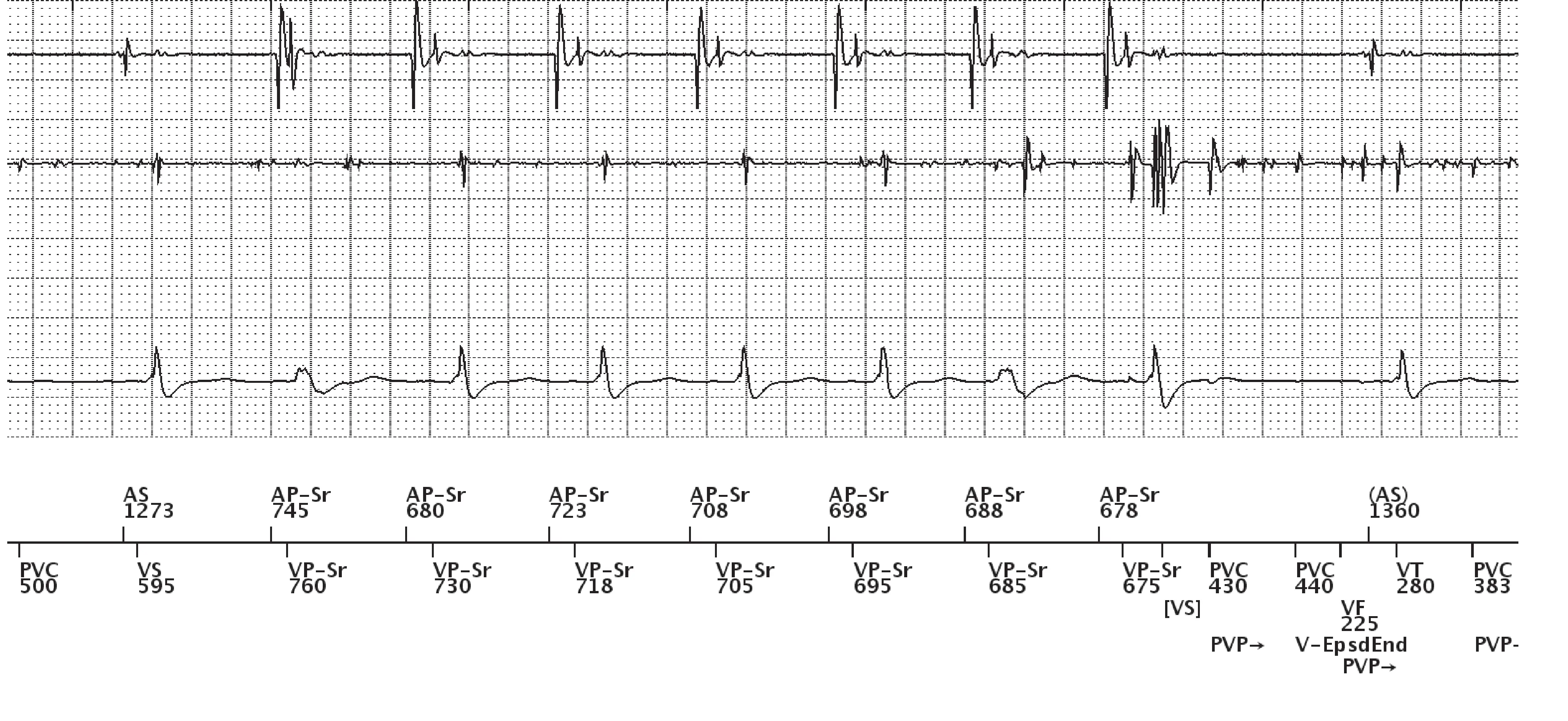 Électrogramme Boston Scientific DAI, segment 3 sur 7 — Surdétection et stimulation anti-tachycardique en zone de FV