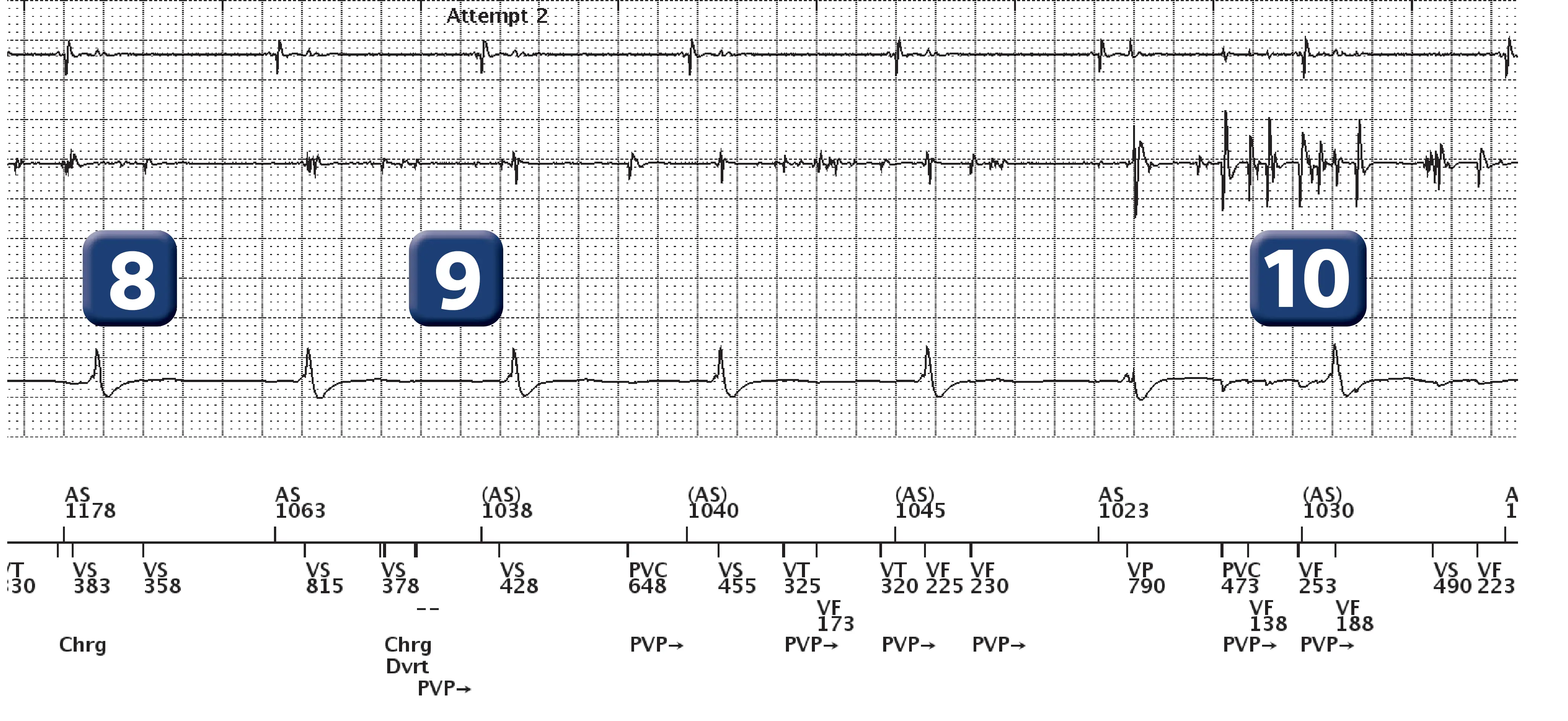 Électrogramme Boston Scientific DAI, segment 5 sur 7 — Surdétection et stimulation anti-tachycardique en zone de FV