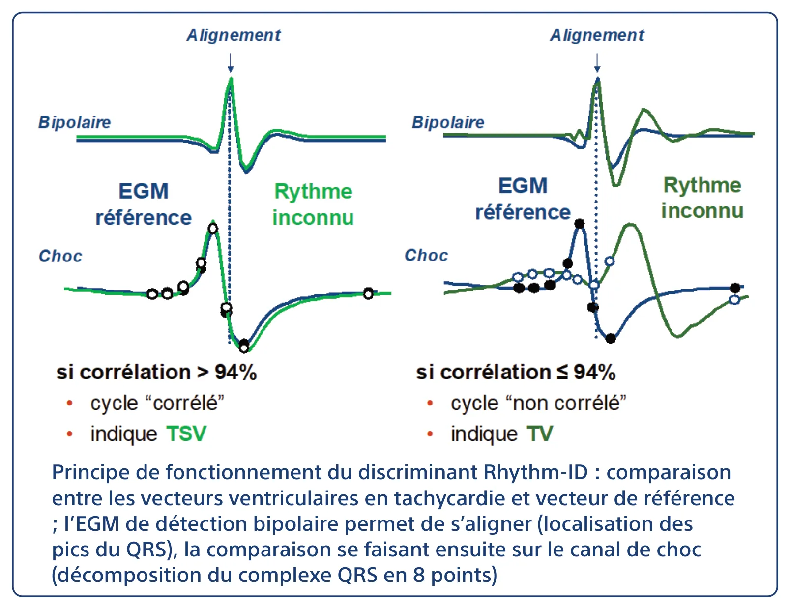 Principe de fonctionnement du discriminant Rhythm-ID : comparaison entre les vecteurs ventriculaires en tachycardie et vecteur de référence ; l’EGM de détection bipolaire permet de s’aligner (localisation des pics du QRS), la comparaison se faisant ensuite sur le canal de choc (décomposition du complexe QRS en 8 points)