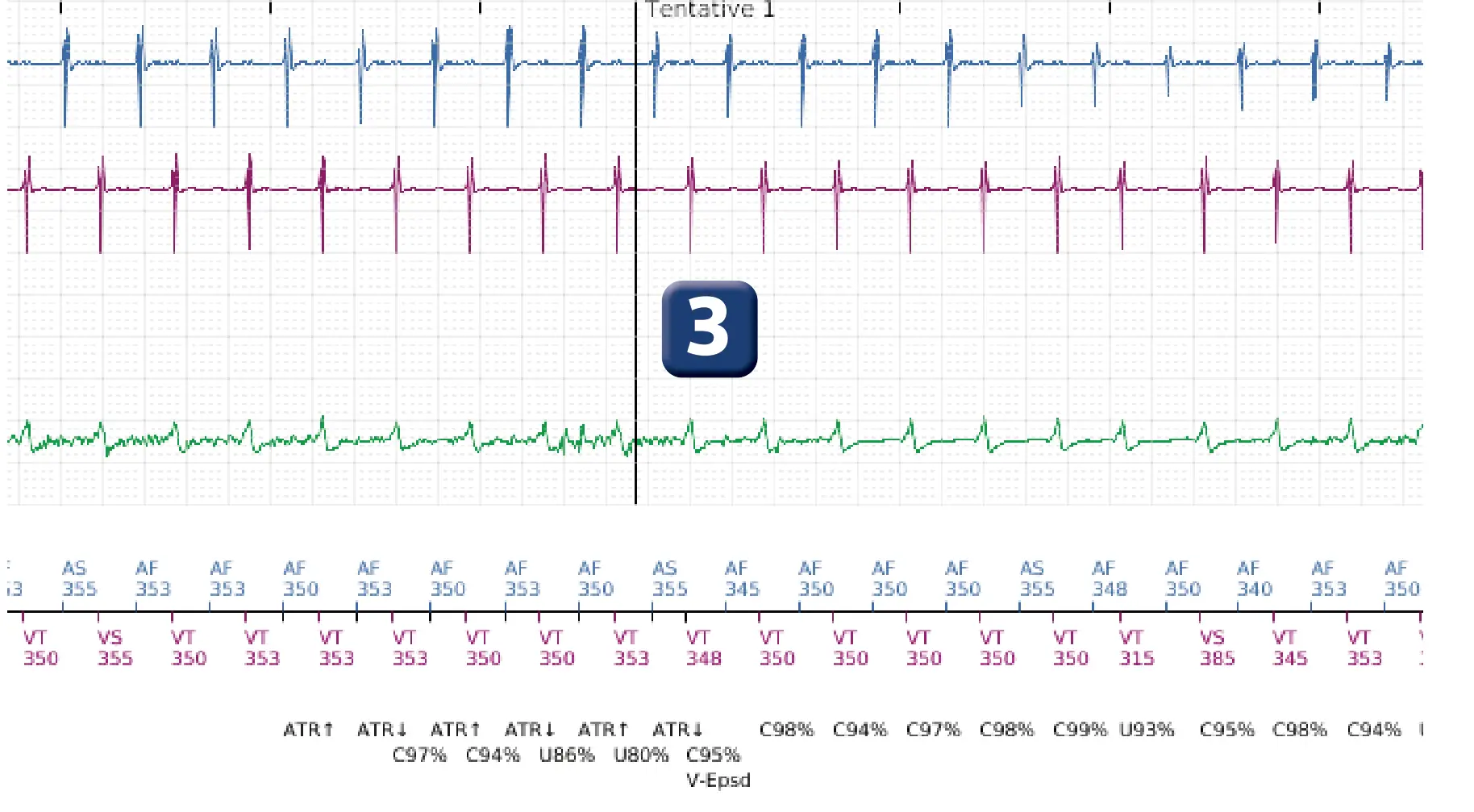Électrogramme Boston Scientific DAI, segment 2 sur 10 — Discrimination double chambre et erreur de discrimination par altération du signal du canal de choc