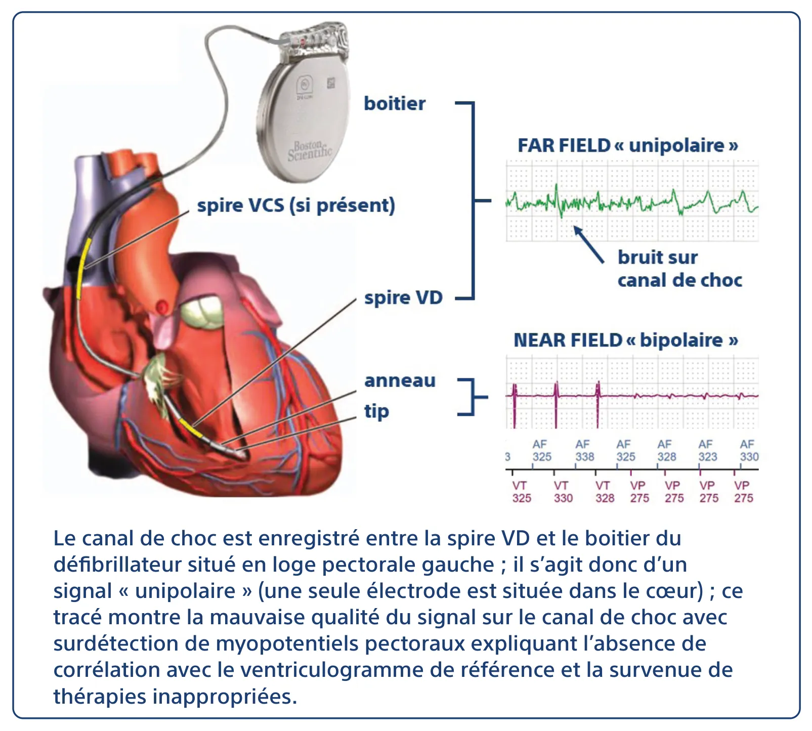 Le canal de choc est enregistré entre la spire VD et le boitier du défibrillateur situé en loge pectorale gauche ; il s’agit donc d’un signal « unipolaire » (une seule électrode est située dans le cœur) ; ce tracé montre la mauvaise qualité du signal sur le canal de choc avec surdétection de myopotentiels pectoraux expliquant l’absence de corrélation avec le ventriculogramme de référence et la survenue de thérapies inappropriées.