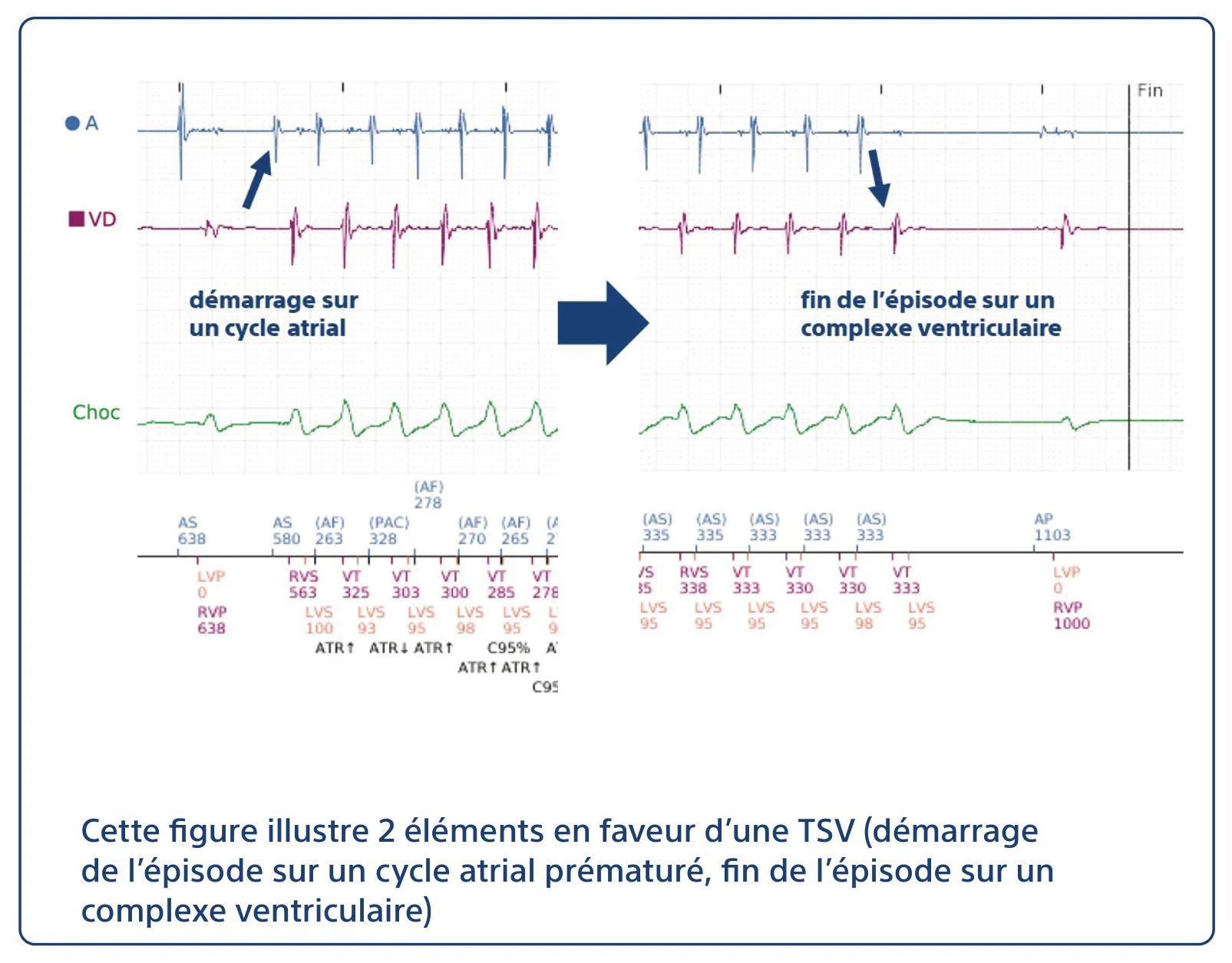 Cette figure illustre 2 éléments en faveur d’une TSV (démarrage de l’épisode sur un cycle atrial prématuré, fin de l’épisode sur un complexe ventriculaire)