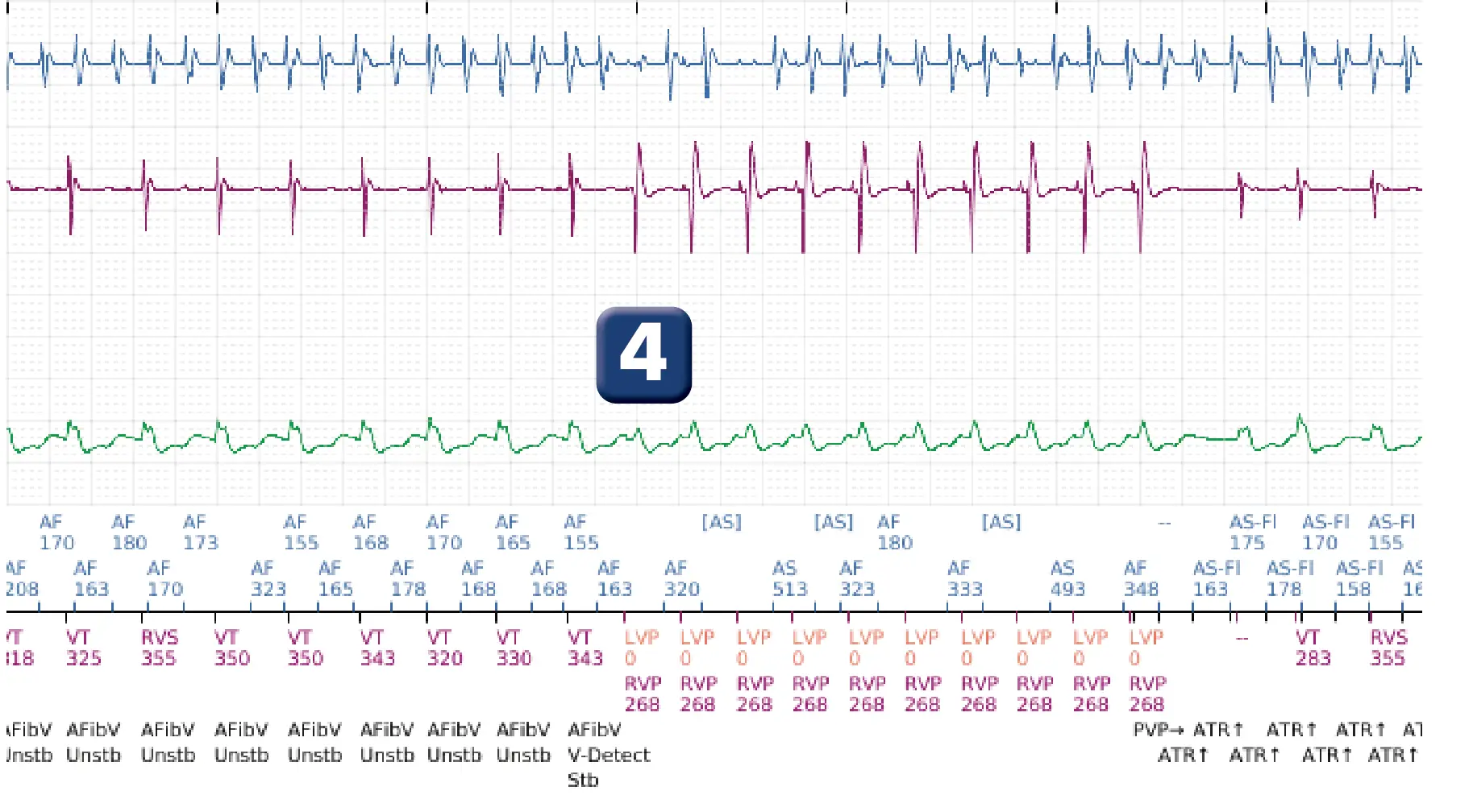 Électrogramme Boston Scientific DAI, segment 9 sur 12 — Discrimination double chambre, fibrillation auriculaire, début/stabilité