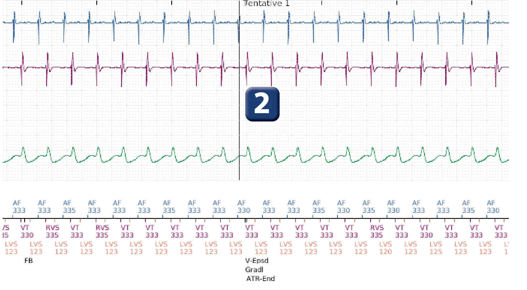 Électrogramme Boston Scientific DAI, segment 2 sur 3 — Discrimination double chambre, tachycardie atriale, début/stabilité