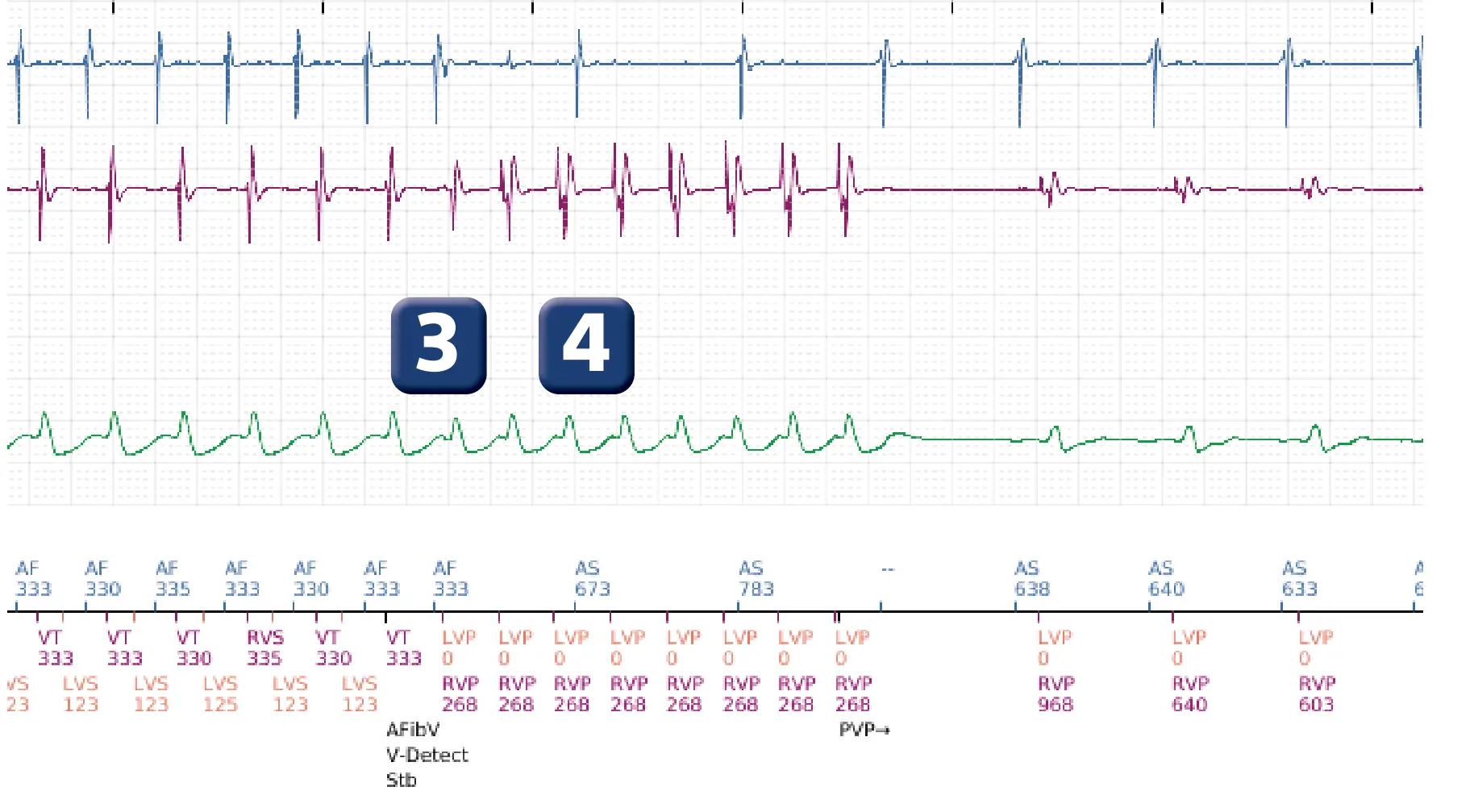 Électrogramme Boston Scientific DAI, segment 3 sur 3 — Discrimination double chambre, tachycardie atriale, début/stabilité
