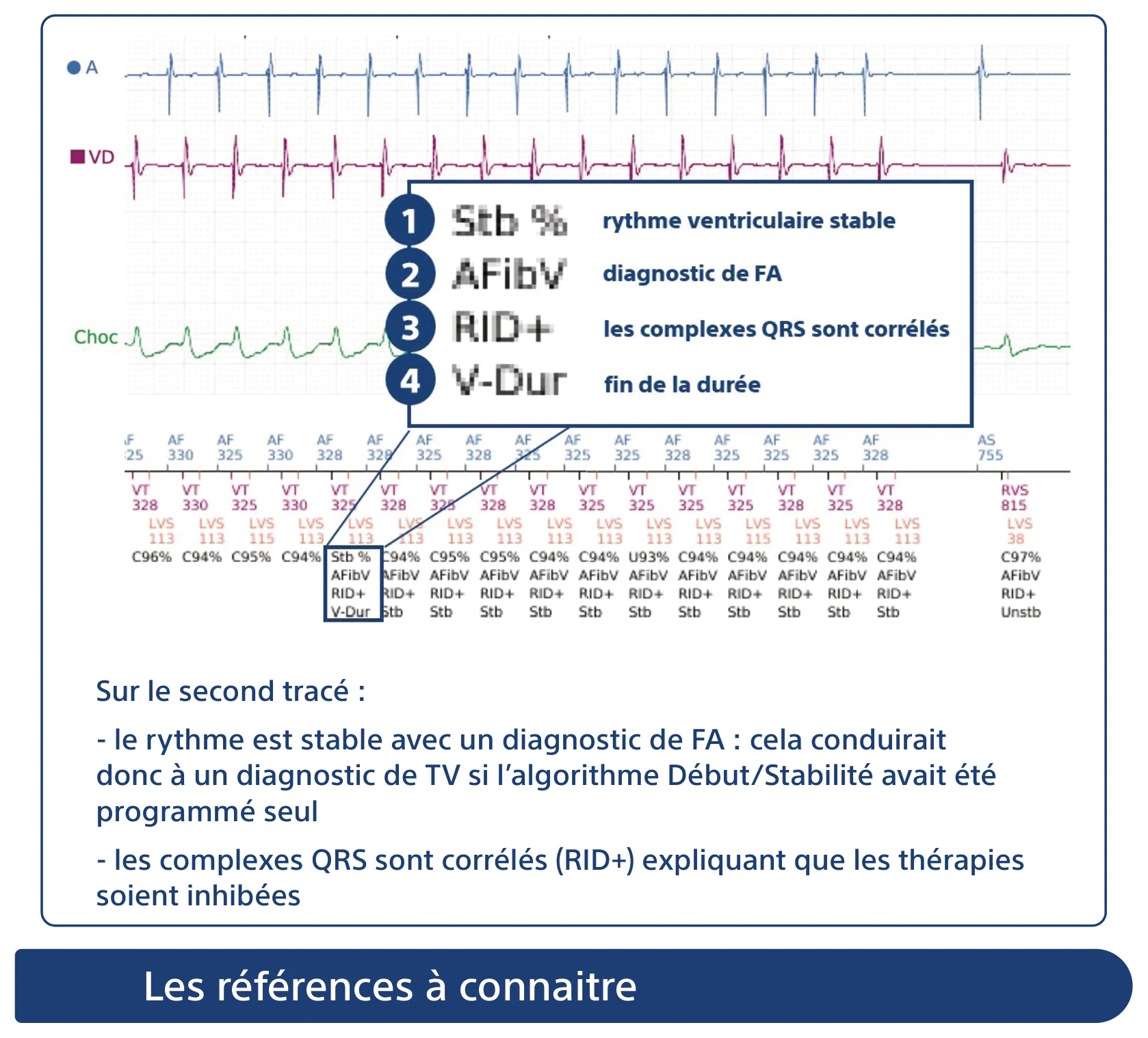Sur le second tracé : - le rythme est stable avec un diagnostic de FA : cela conduirait donc à un diagnostic de TV si l’algorithme Début/Stabilité avait été programmé seul - les complexes QRS sont corrélés (RID+) expliquant que les thérapies soient inhibées