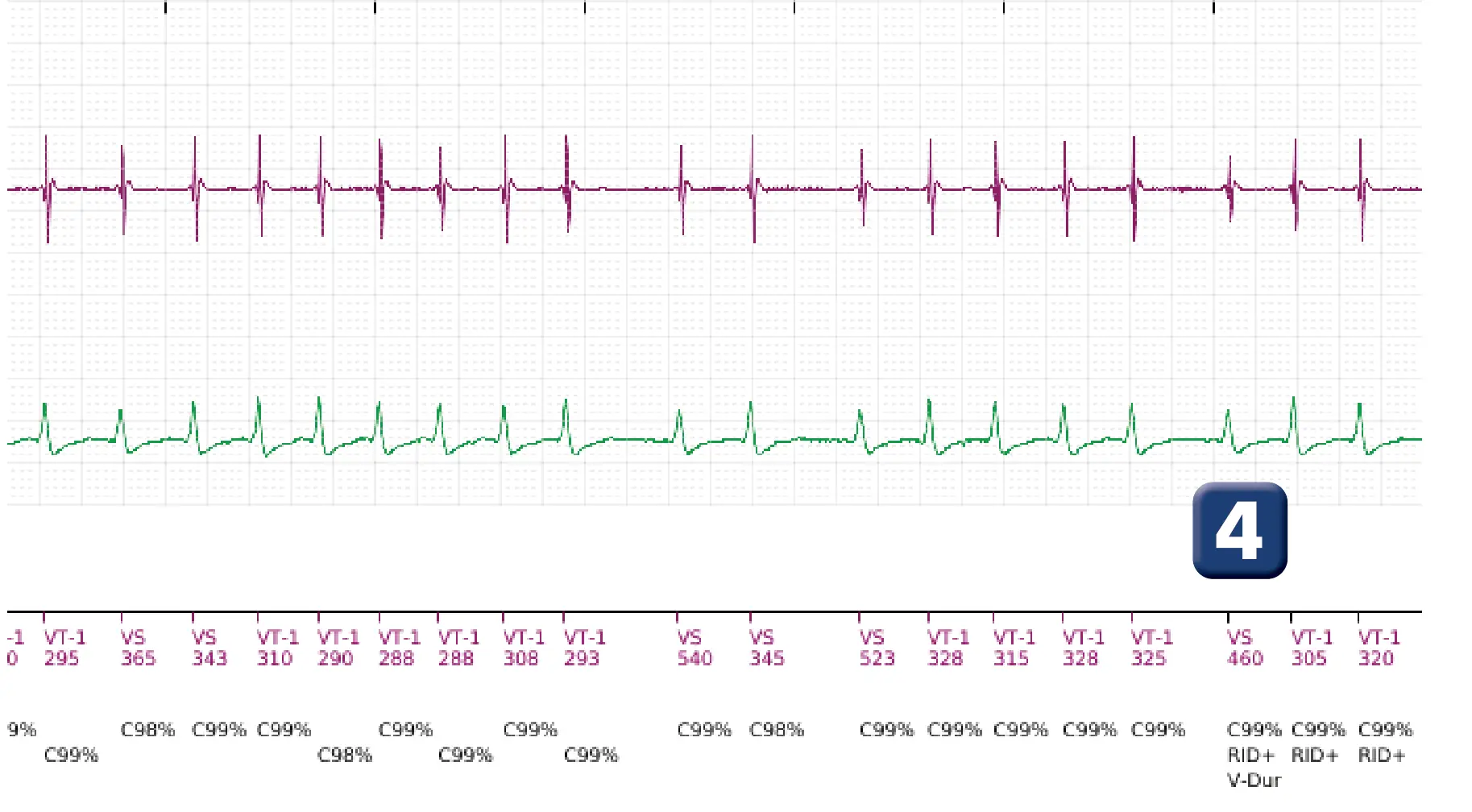 Électrogramme Boston Scientific DAI, segment 4 sur 5 — Discrimination simple chambre, ID de rythme et épisode de fibrillation auriculaire