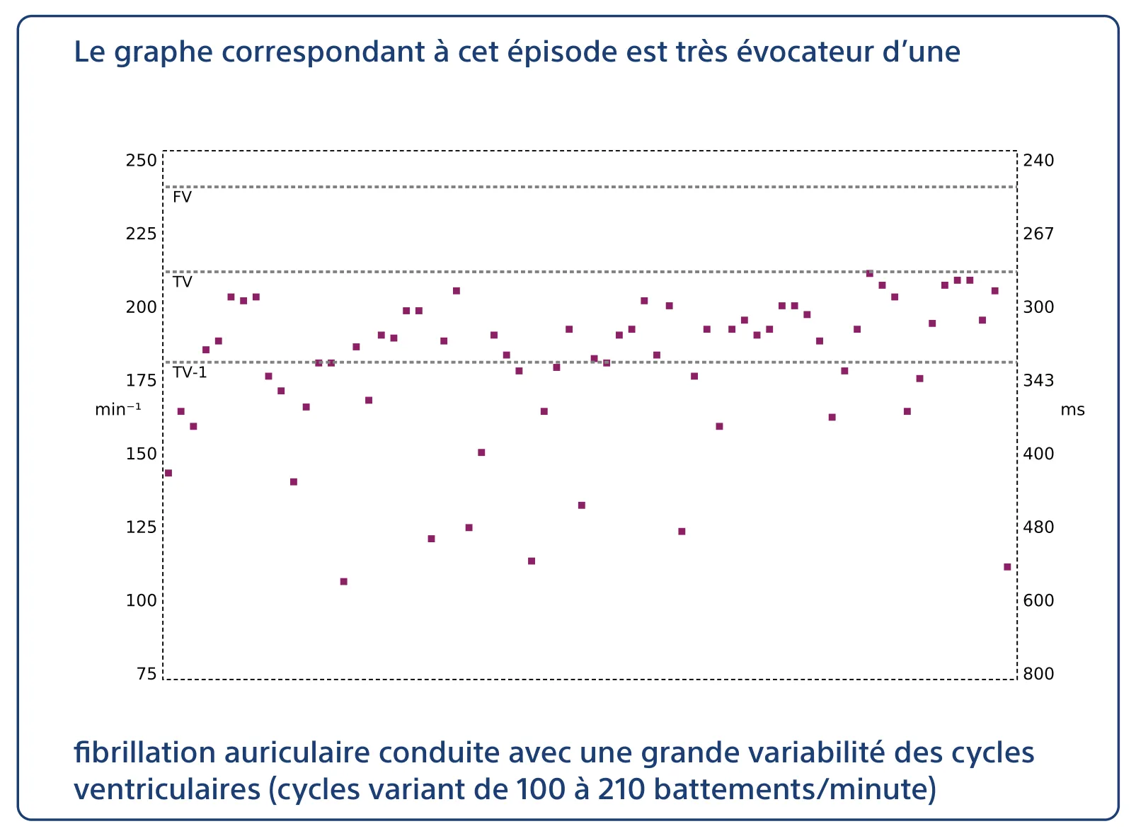 Le graphe correspondant à cet épisode est très évocateur d’une fibrillation auriculaire conduite avec une grande variabilité des cycles ventriculaires (cycles variant de 100 à 210 battements/minute)