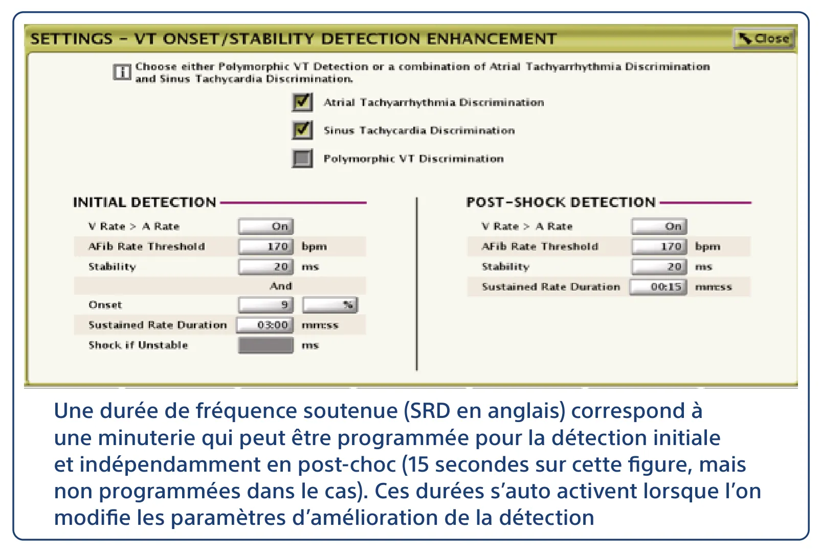 Une durée de fréquence soutenue (SRD en anglais) correspond à une minuterie qui peut être programmée pour la détection initiale et indépendamment en post-choc (15 secondes sur cette figure, mais non programmées dans le cas). Ces durées s’auto activent lorsque l’on modifie les paramètres d’amélioration de la détection
