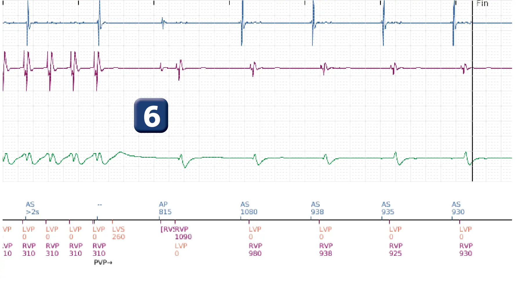 Électrogramme Boston Scientific DAI, segment 5 sur 5 — Discrimination double chambre et V>A