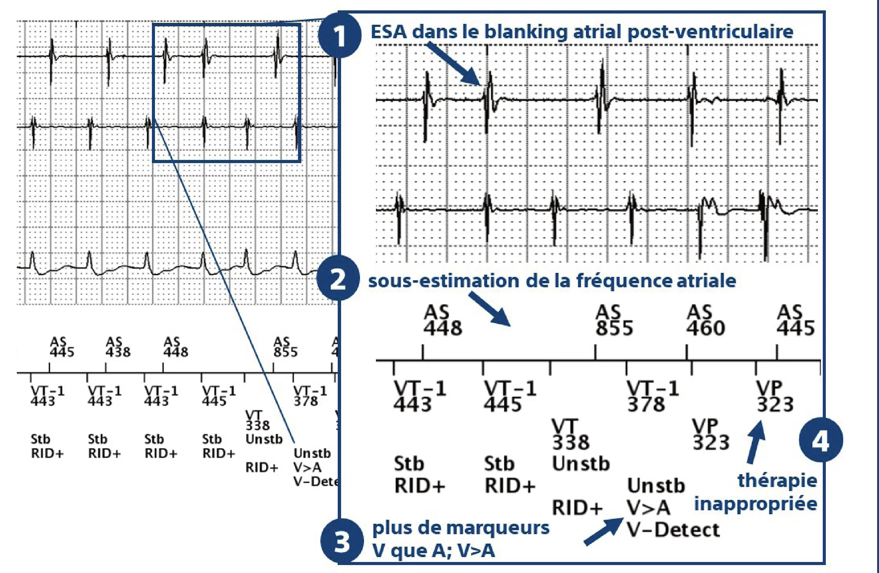 Électrogramme Boston Scientific DAI, segment 14 sur 14 — Discrimination double chambre, périodes réfractaires atriales et critère V>A