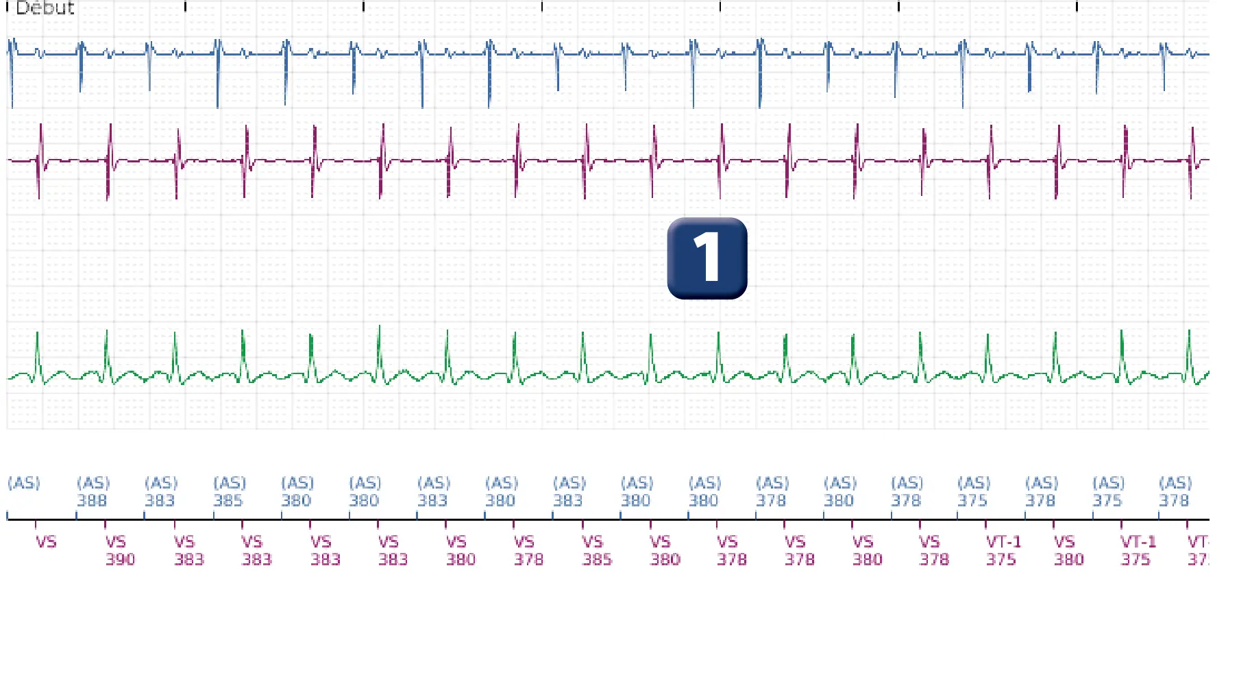 Électrogramme Boston Scientific DAI, segment 1 sur 5 — Discrimination double chambre et tachycardie sinusale