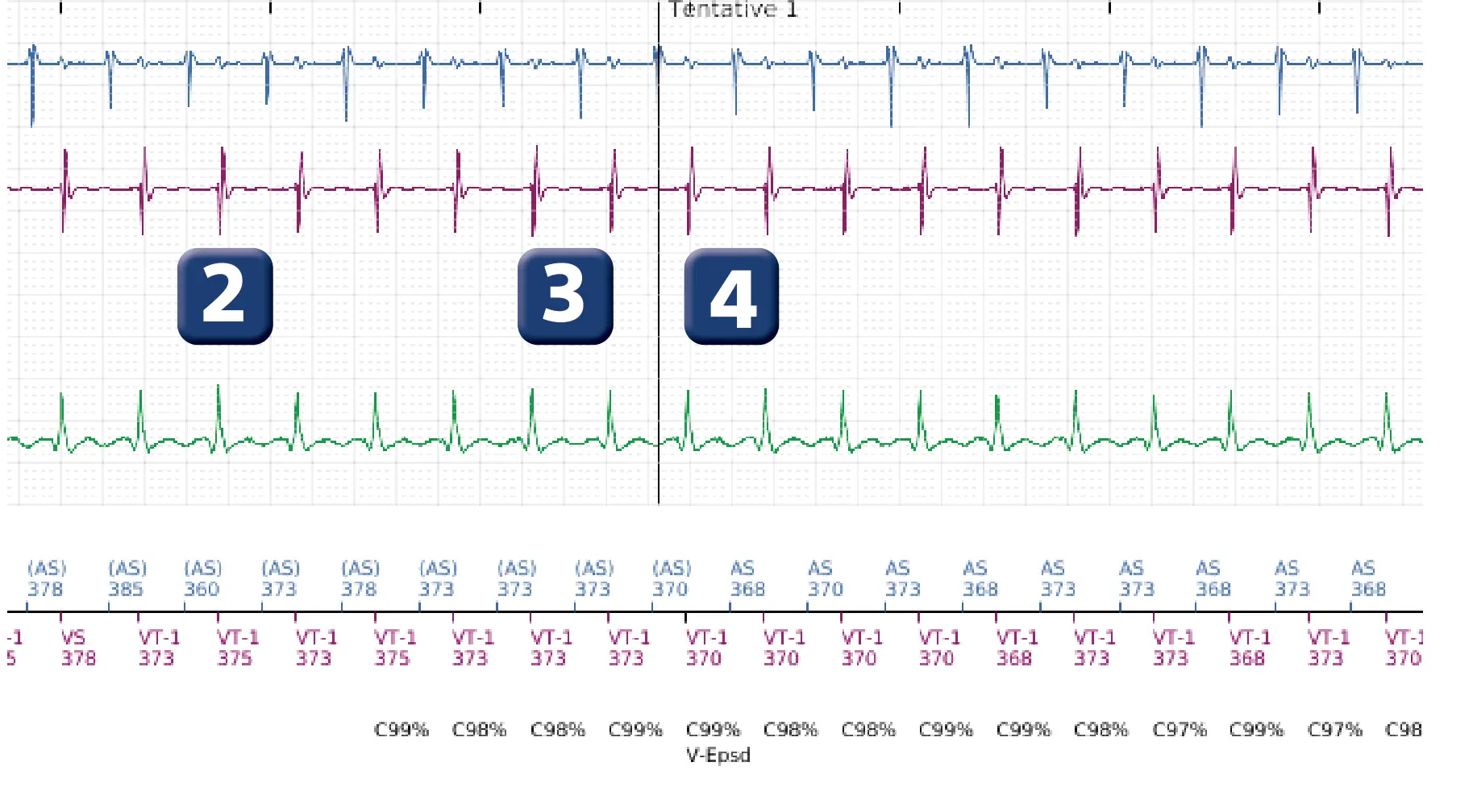 Électrogramme Boston Scientific DAI, segment 2 sur 5 — Discrimination double chambre et tachycardie sinusale