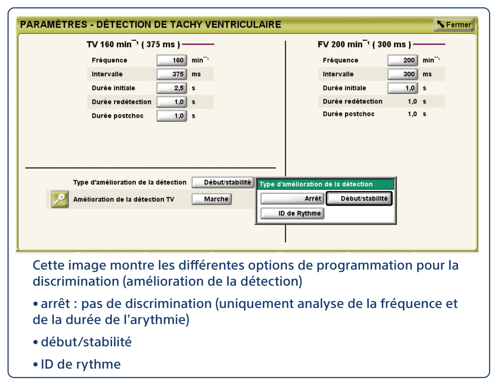Cette image montre les différentes options de programmation pour la discrimination (amélioration de la détection) • arrêt : pas de discrimination (uniquement analyse de la fréquence et de la durée de l’arythmie) • début/stabilité • ID de rythme