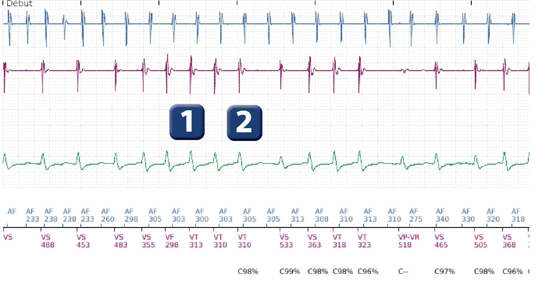 Électrogramme Boston Scientific DAI, segment 1 sur 5 — Discrimination double chambre et tachycardie atriale