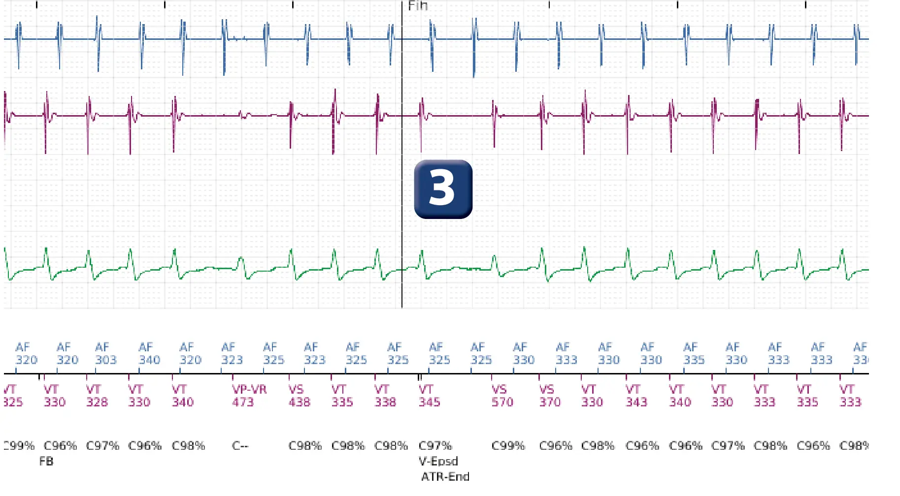 Électrogramme Boston Scientific DAI, segment 2 sur 5 — Discrimination double chambre et tachycardie atriale