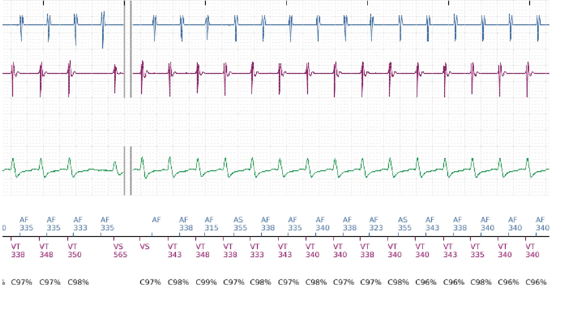 Électrogramme Boston Scientific DAI, segment 3 sur 5 — Discrimination double chambre et tachycardie atriale