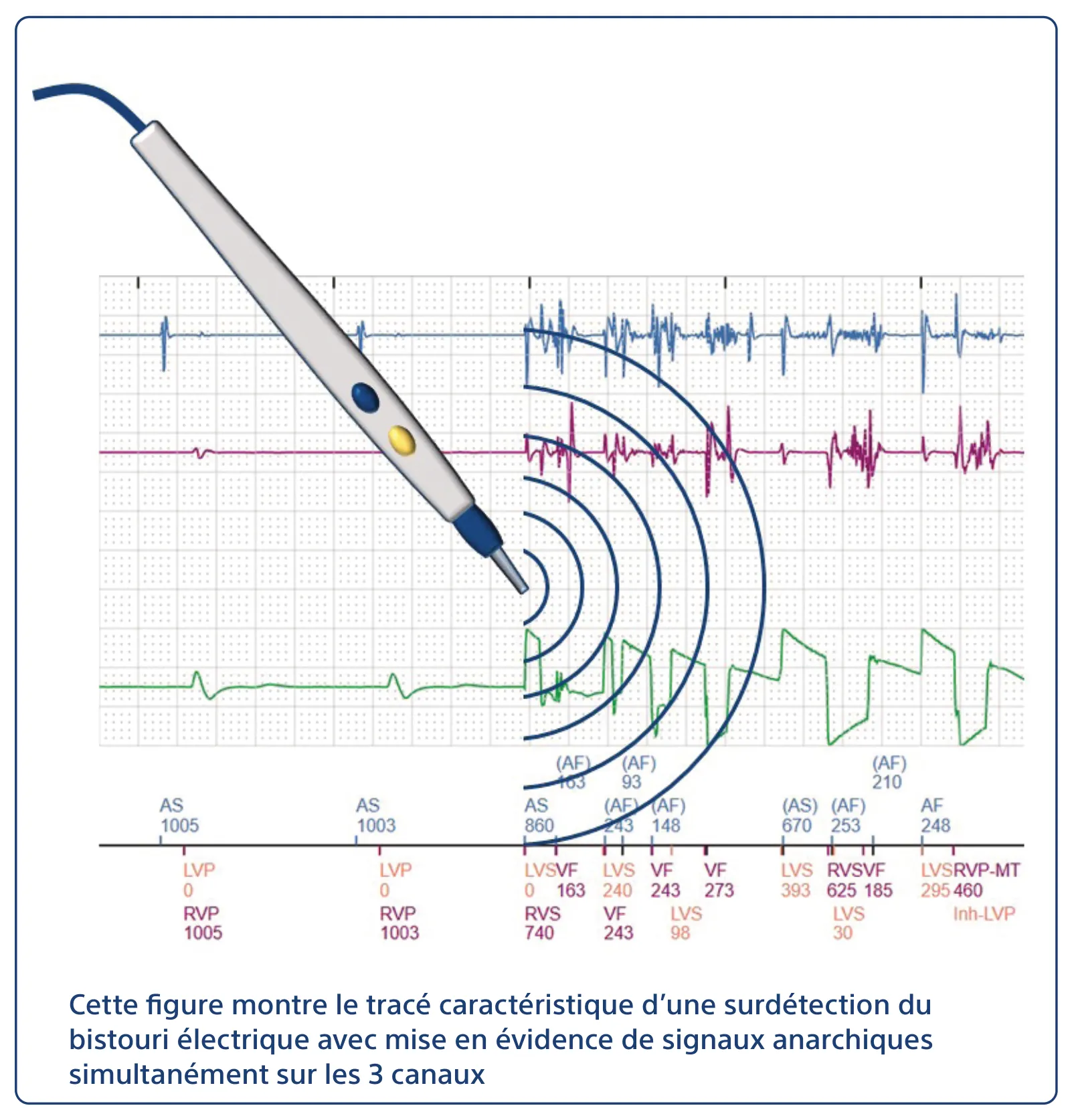 Cette figure montre le tracé caractéristique d’une surdétection du bistouri électrique avec mise en évidence de signaux anarchiques simultanément sur les 3 canaux