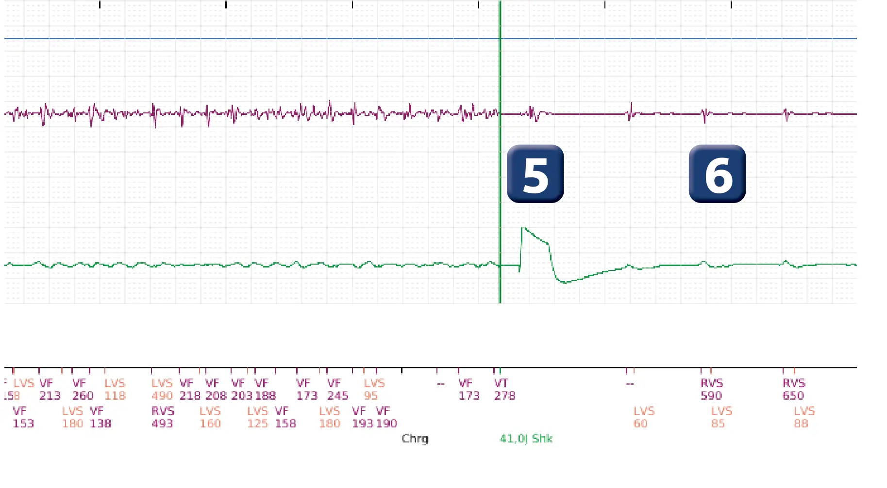 Électrogramme Boston Scientific DAI, segment 4 sur 5 — Intervention chirurgicale et FV au moment de la reperfusion