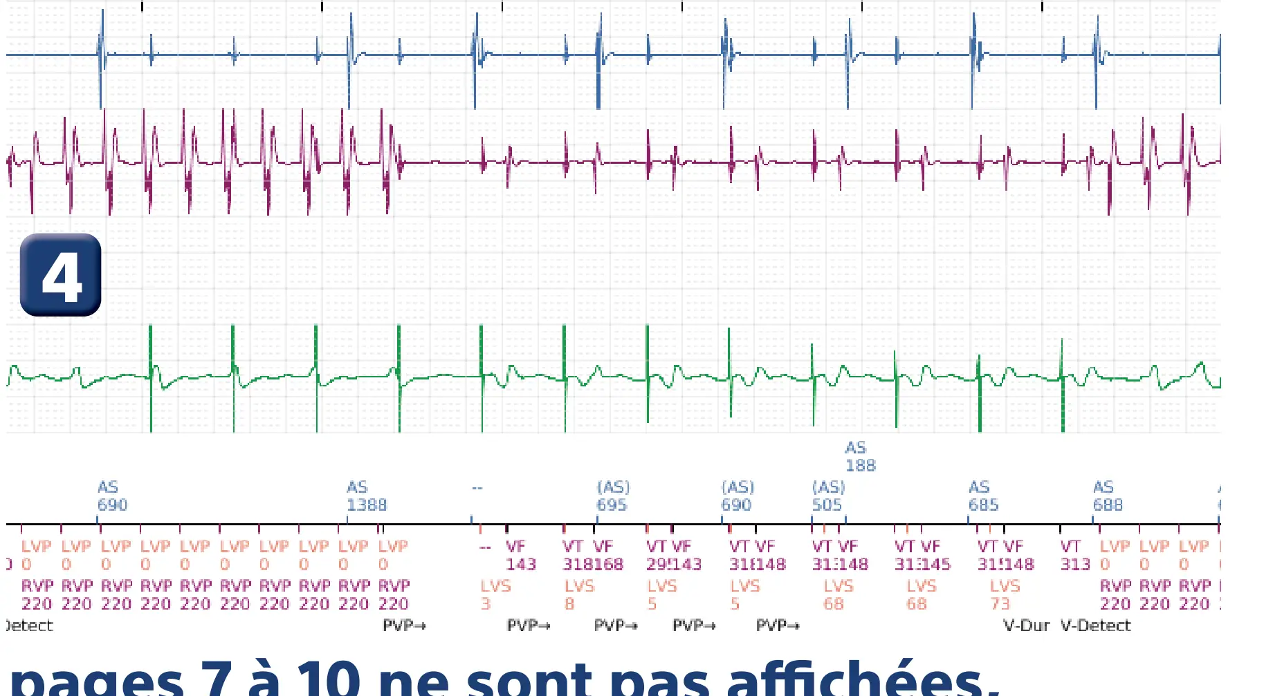 Électrogramme Boston Scientific DAI, segment 4 sur 6 — Thérapies inappropriées lors d’une procédure de TAVI