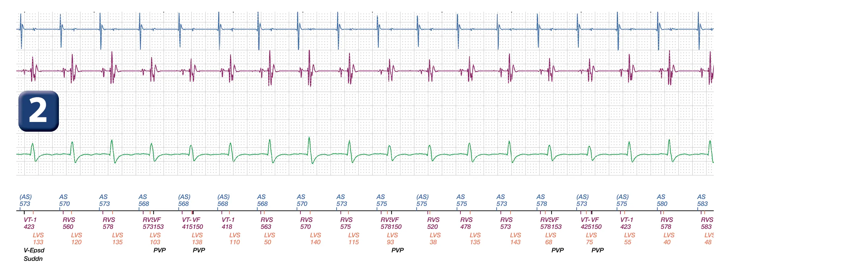 Électrogramme Boston Scientific DAI, segment 2 sur 2 — Surdétection de l’onde P