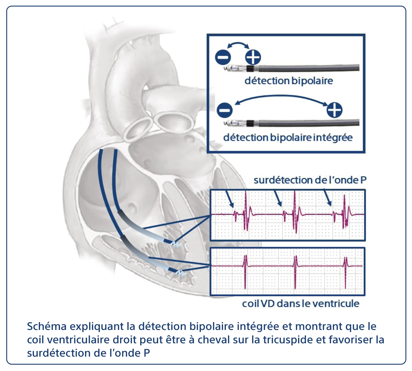 Schéma expliquant la détection bipolaire intégrée et montrant que le coil ventriculaire droit peut être à cheval sur la tricuspide et favoriser la surdétection de l’onde P