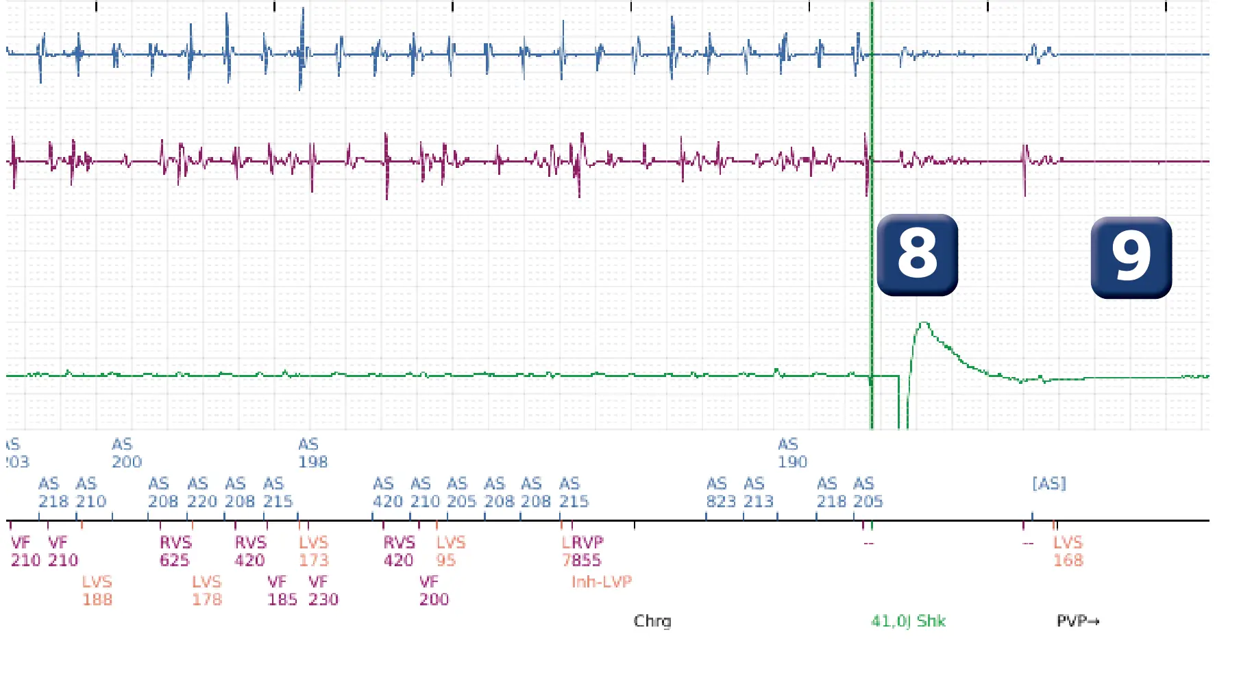 Électrogramme Boston Scientific DAI, segment 7 sur 8 — Déplacement précoce de la sonde ventriculaire droite dans l’oreillette