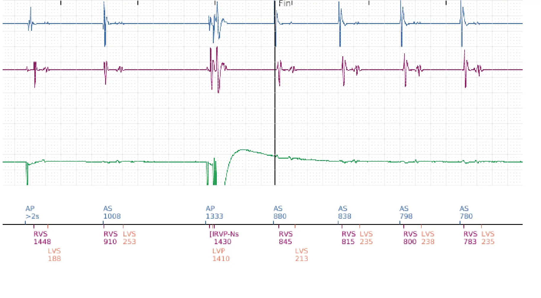 Électrogramme Boston Scientific DAI, segment 8 sur 8 — Déplacement précoce de la sonde ventriculaire droite dans l’oreillette