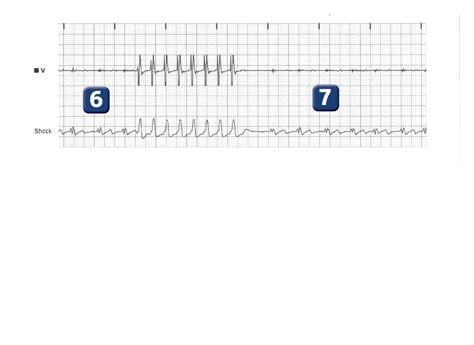 Électrogramme Boston Scientific DAI, segment 4 sur 5 — Surdétection de l’onde T