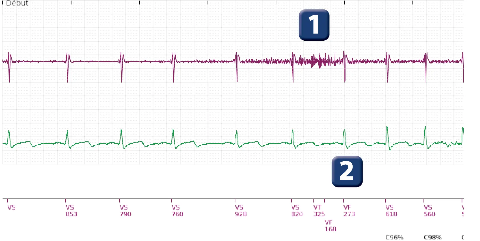 Électrogramme Boston Scientific DAI, segment 1 sur 2 — Surdétection de myopotentiels diaphragmatiques