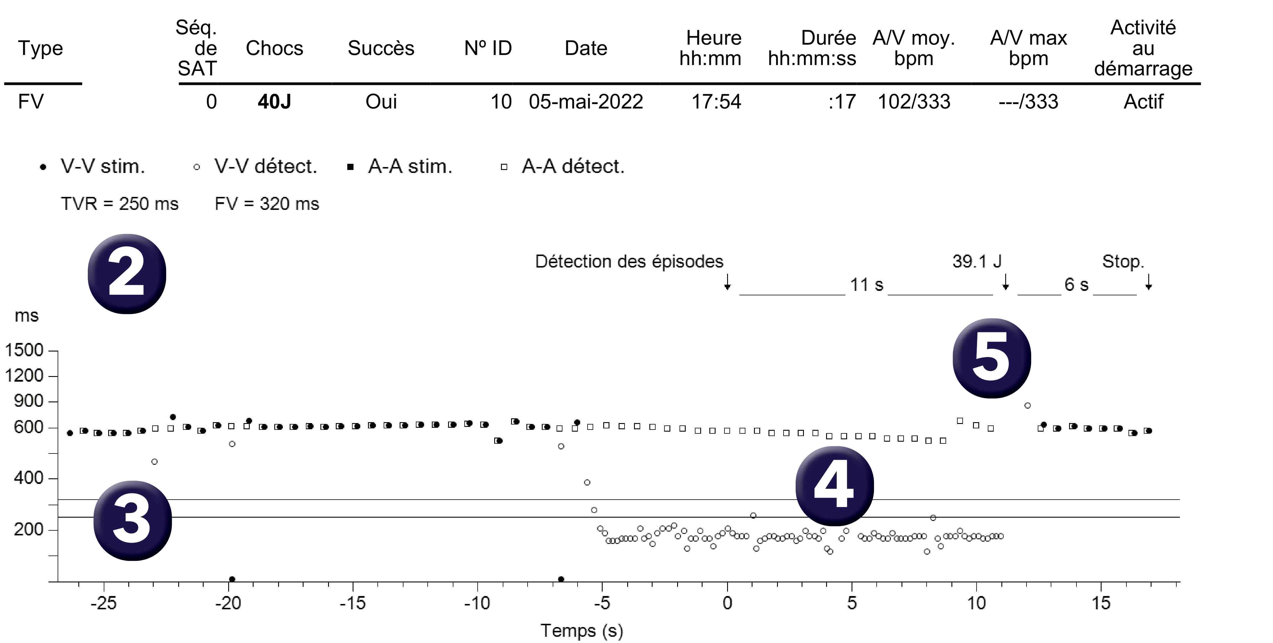 Électrogramme Medtronic DAI, segment 1 sur 2 — Analyse d’un tracé de FV enregistré par le dispositif