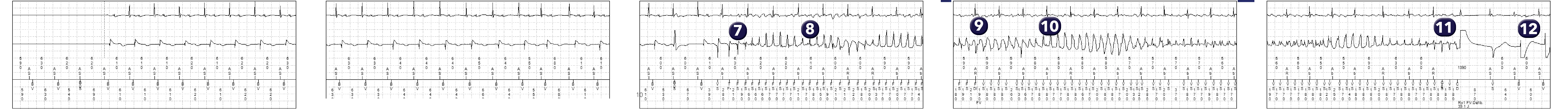 Électrogramme Medtronic DAI, segment 1 sur 2 — Analyse d’un tracé de FV enregistré par le dispositif