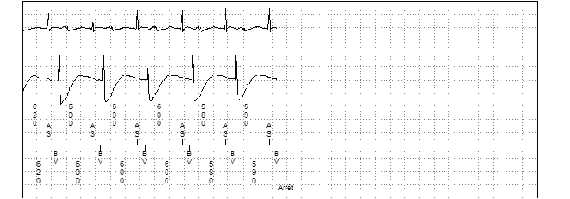 Électrogramme Medtronic DAI, segment 2 sur 2 — Analyse d’un tracé de FV enregistré par le dispositif