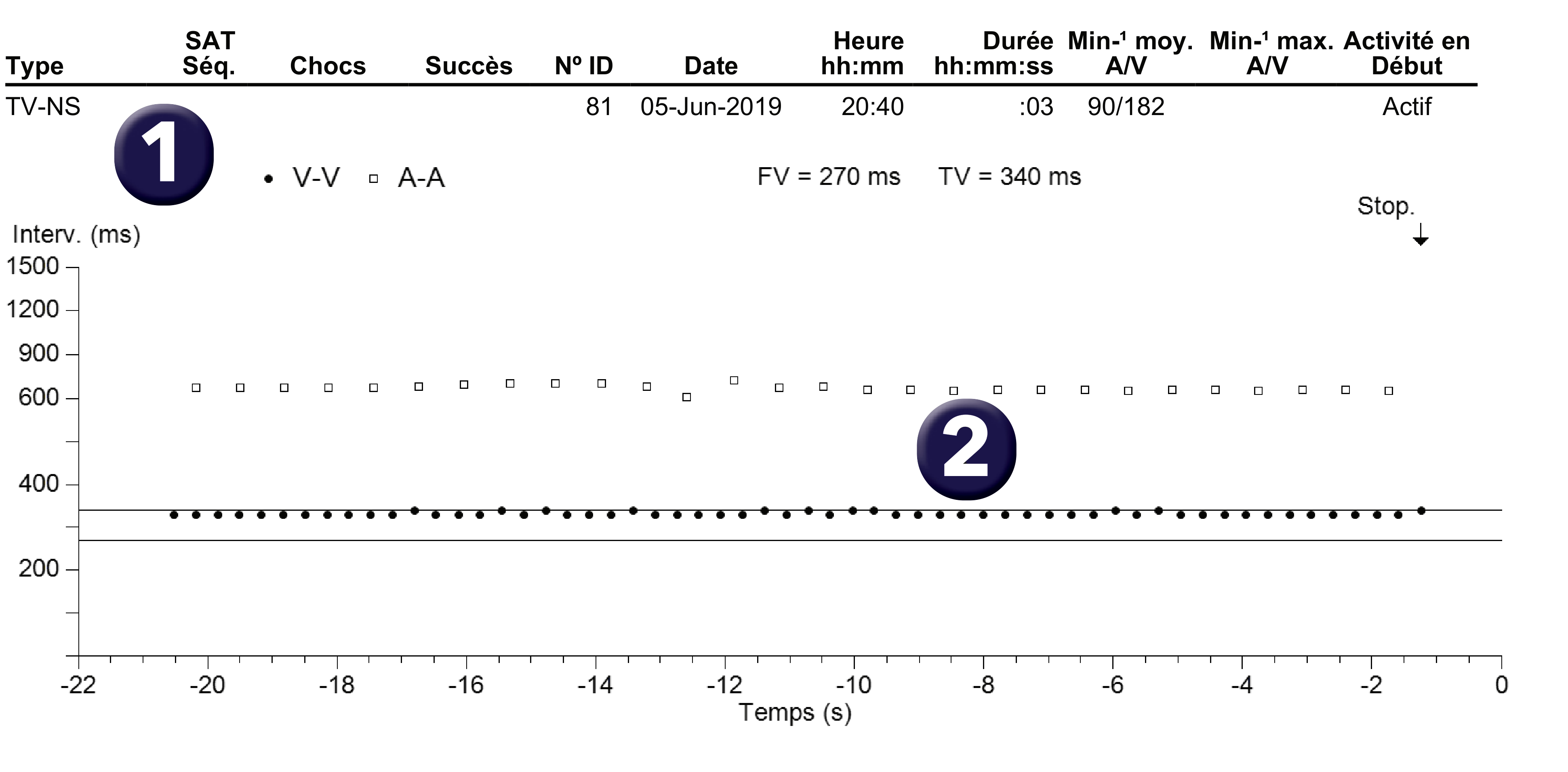 Électrogramme Medtronic DAI, segment 1 sur 1 — Limite de zone et compteur de TV