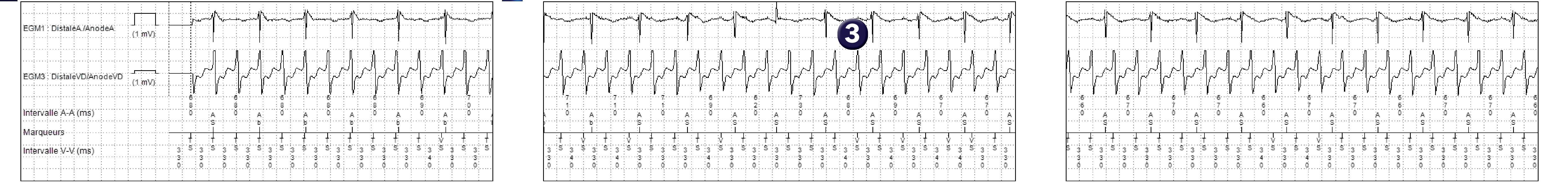 Électrogramme Medtronic DAI, segment 1 sur 1 — Limite de zone et compteur de TV