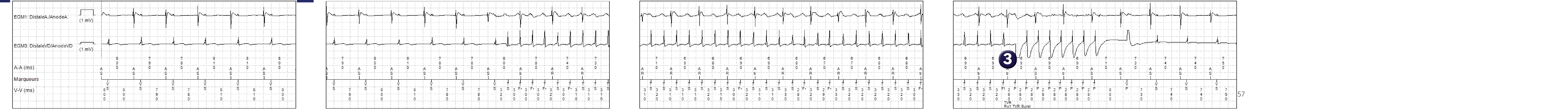 Électrogramme Medtronic DAI, segment 1 sur 1 — TV rapide et compteur combiné