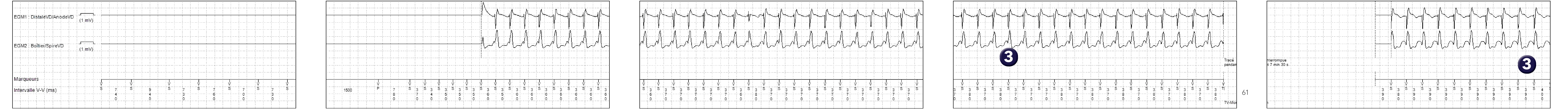 Électrogramme Medtronic DAI, segment 1 sur 2 — TV et zone moniteur
