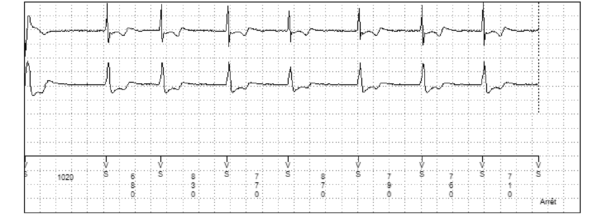Électrogramme Medtronic DAI, segment 2 sur 2 — TV et zone moniteur
