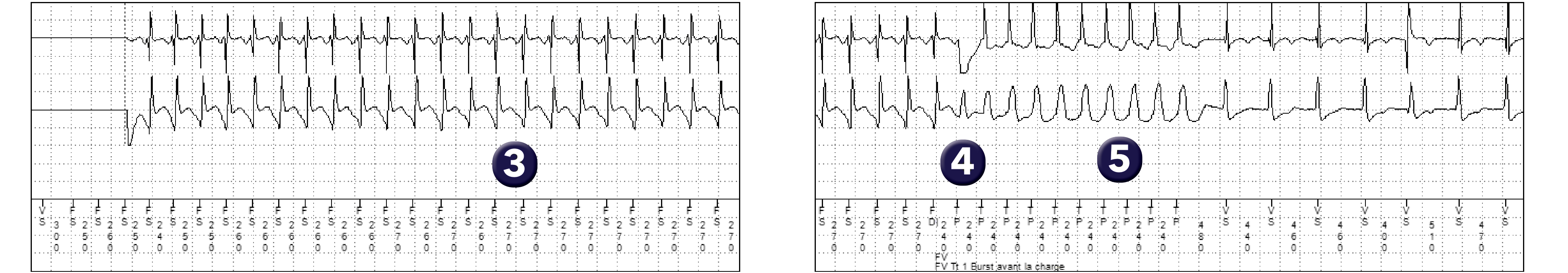 Électrogramme Medtronic DAI, segment 1 sur 1 — Une arythmie ventriculaire organisée en zone de FV