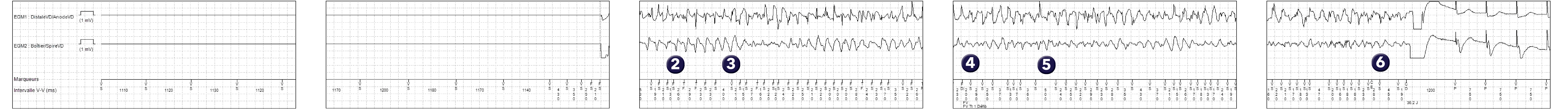 Électrogramme Medtronic DAI, segment 1 sur 2 — Utilité d’un compteur probabiliste en zone de FV