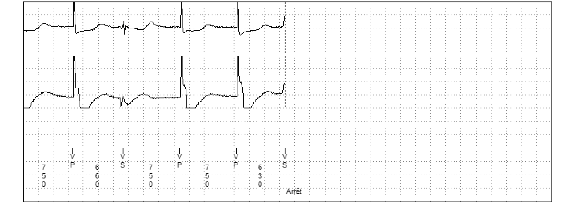 Électrogramme Medtronic DAI, segment 2 sur 2 — Utilité d’un compteur probabiliste en zone de FV