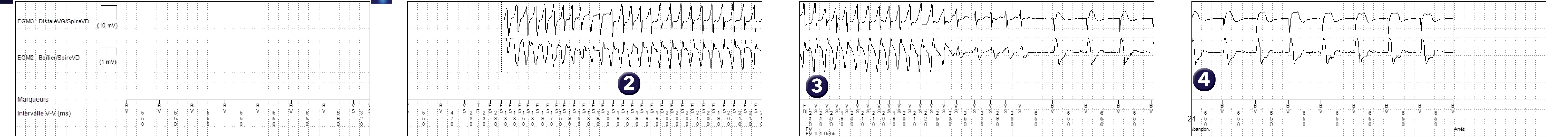 Électrogramme Medtronic DAI, segment 1 sur 1 — Réduction spontanée d’une arythmie ventriculaire